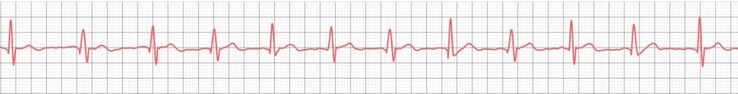 The iHEAL 6 not only evaluates the ECG, but can also display it graphically