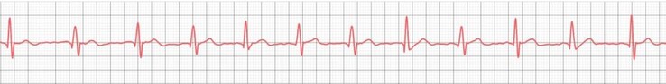 The iHEAL 6 not only evaluates the ECG, but can also display it graphically