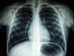 An X-ray image of a human torso (Image source: Umanoide via Unsplash; cropped)