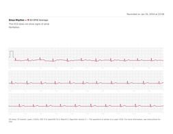 An ECG recorded on the Apple Watch to compare...