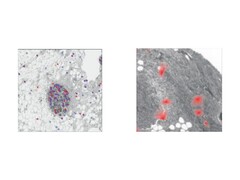 Spatial and tissue-specific organisation of cellular senescence (a process in which damaged or aging cells stop dividing but remain active). (Image source: The Lancet Digital Health)