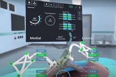 The STELLAR Knee interface displaying the calculated dimensions and positions of leg bones during knee surgery. (Source: PolarisAR on Youtube)