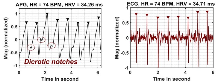 APG readings compare favourably with those from ECG (Image Source: Google Research)