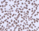 Red blood cells forming rouleaux. (Image source: Wikimedia Commons)