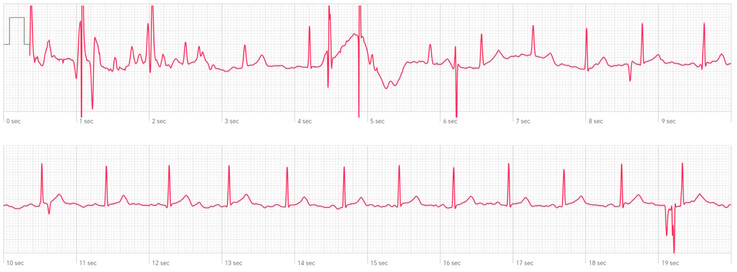 Derivation II according to Einthoven: Here, the Huawei Watch D2 is already being used well beyond its specifications—but the ECG remains perfectly usable.