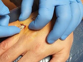 The Tesla car key implant can be inserted via a small skin incision (image: Brandon Dalaly/Twitter)