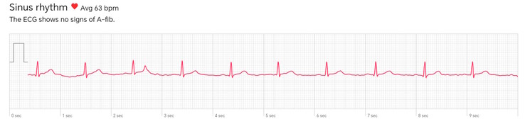 Excerpt from an ECG recorded by the Watch D3: This is how it should look; the subject has no arrhythmias.