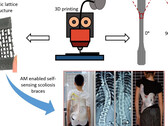 New scoliosis treatment research uses smart 3D-printed back brace to fix posture in children with spine deformity without surgery