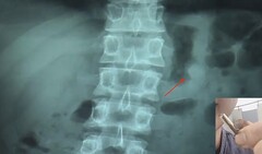 AirPod inside the stomach and outside the bathroom. (Image source: Daily Mail/AsiaWire/edited)