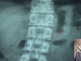 AirPod inside the stomach and outside the bathroom. (Image source: Daily Mail/AsiaWire/edited)