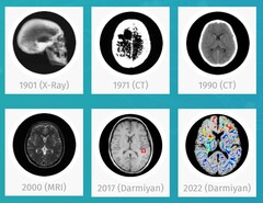 Darmiyan BrainSee medical AI software can detect signs of Alzheimer's early on. (Source: Darmiyan)