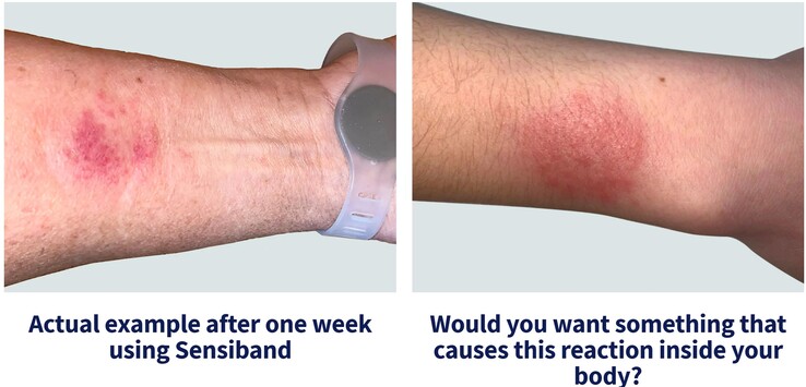 Skin and blood tests are complex and expensive while the Sensiband is easy to wear and use. (Source: Sensiband)