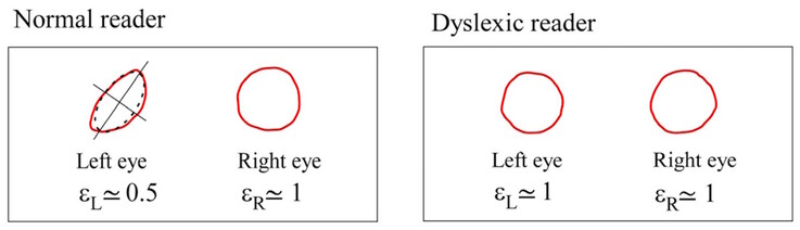Maxwell's centroids differ in symmetry in normal subjects, but are similar in dyslexic subjects. (Image source: DOI 10.3390/brainsci13101478)