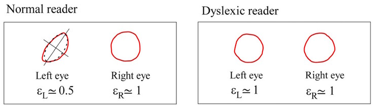 Maxwell's centroids differ in symmetry in normal subjects, but are similar in dyslexic subjects. (Image source: DOI 10.3390/brainsci13101478)