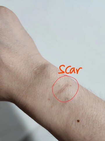 The scar left after the alleged burn caused by the Galaxy Watch 8.