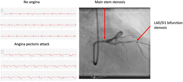 The Apple Watch's "normal" (top) and ischemia-related (bottom) ECG readouts, next to an image of the anomalies causing the latter. (Source: European Heart Journal)