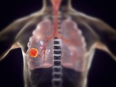 In 2022 alone, 131,888 people died from lung cancer in the US. (Image source: KATERYNA KON/SCIENCE PHOTO LIBRARY/Getty Images)