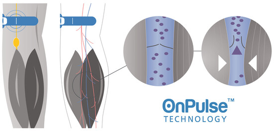 OnPulse (Image source: Sky Medical)