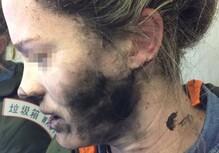 Facial burns caused by Beats headphones blast. (Image source: Neowin)