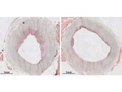 Plaque levels in an artery before and after the nanotherapy infusion. (Image source: MSU Today)
