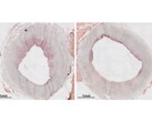 Plaque levels in an artery before and after the nanotherapy infusion. (Image source: MSU Today)